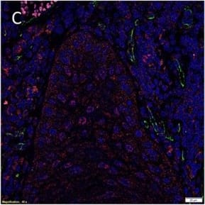 Immunocytochemistry/ Immunofluorescence: Nanog Antibody (5A10) - BSA Free [NBP1-04320] - Representative IF IHC-stained sections of MDBMSCC demonstrating the expression of pSTAT3 [(A), red] & EMA [(A), green] by cells within the tumor nests. There was a CSC subpopulation remonstrating nuclear co-expression of STAT3 [(B), red] & CD34 [(B), green], appearing as orange, on the endothelium of the microvessels within the stroma; & another subpopulation staining only positively for pSTAT3 within the stroma [(B), red]. Nuclear expression of NANOG [(C), red] was demonstrated on the endothelium of the microvessels which expressed CD34 [(C), green] within stroma. The NANOG+ cells [(C), red] that do not express CD34 were seen within the tumor nests & the stroma. SOX2 [(D), red] was also expressed by cells within tumor nests & the stroma, & the endothelium of the microvessels expressing CD34 [(D), green]. Nuclear expression of both SOX2 [(E), red] & SALL4 [(E), green], appearing as orange, was seen on the cells within the tumor nests & the stroma. Expression of both SOX2 [(F), red] & OCT4 [(F), green], appearing as orange, was seen on cells within the tumor nests & the stroma, & the endothelium of the microvessels within the stroma. pSTAT3 [(G), red] & membranous staining CD44 [(G), green] were co-expressed by cells within the tumor nests. Scale bars: 20 μm. Image collected & cropped by CiteAb from the following publication (//journal.frontiersin.org/Article/10.3389/fsurg.2016.00046/abstract), licensed under a CC-BY license. Not internally tested by Novus Biologicals.