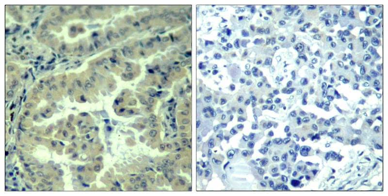 Immunohistochemistry-Paraffin: eIF4G1 [p Ser1231] Antibody [NBP1-04965] - Immunohistochemical analysis of paraffin-embedded human lung carcinoma tissue using NBP1-04965 incubated with blocking peptide(right).