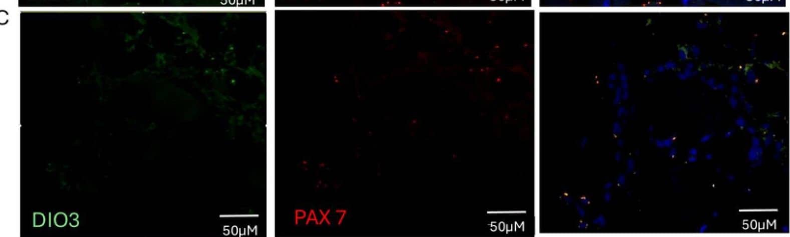 Type 3 deiodinase expression and colocalization on muscle. (A) DIO3 expression is augmented in the muscle of the critically ill, specifically in those with NTIS. (B) panel. RNAscope showing the colocalization of DIO3 and MYOD+, augmented in patients with T3 levels < 35 ng/dL. (C) RNAscope showing that DIO3 and PAX7+ do not colocalize in patients with T3 levels < 35 ng/dL. (D) RNAscope of DIO3 and DIO2, also shows that these genes do not colocalize in patients with T3 levels < 35 ng/dL. DAPI (blue), DIO3 (green), MYOD, PAX7, DIO2. (red) * p = 0.001, ** p < 0.0001. ns: Statistically not significant. Image collected and cropped by CiteAb from the following open publication (//pubmed.ncbi.nlm.nih.gov/40141055), licensed under a CC-BY license. Not internally tested by Novus Biologicals.