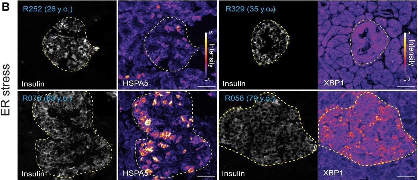 Beta cell TFs, ER stress, and autophagy markers in aging beta cells.Immunohistochemistry and confocal microscopy of human pancreas formalin-fixed paraffin-embedded samples from adults (22 to 35 years old) and old adults (61 to 79 years old). Human islets were stained with (A) insulin, PDX1, NKX6-1, and/or NKX2-2; (B) insulin and HSPA5 or XBP1; and (C) insulin, LC3A/B, and LAMP1. (D) Quantification of LC3-LAMP1 colocalization, area of beta cell cytosol covered by LAMP1+ granules, and LAMP1+ granule size. Each dot represents data from a single region of ~140 μm2 of human islets. Here, 1 region per islet, 10 regions per donor were quantified. In (A) and (B), the islet region is demarcated by the dotted yellow line. Scale bars, 50 μm (A and B), 20 μm (C), and 5 μm (inset of C). CI, confidence interval. Image collected and cropped by CiteAb from the following open publication (//pubmed.ncbi.nlm.nih.gov/36197983), licensed under a CC-BY license. Not internally tested by Novus Biologicals.