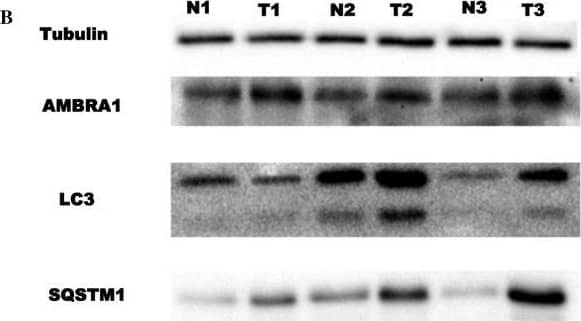 Western Blot: AMBRA1 Antibody - BSA Free [NBP1-07124] - a Immunohistochemical results showing the prevalence of AMBRA1 (left) & SQSTM1 (right) based on a semi-quantitative total score. Frequency distribution of the protein is reported according to the Gleason grade classification (GL6–GL8). A trend of AMBRA1 high score values correlation with the higher grade of Gleason score is visible. As opposite the levels of SQSTM1 positivity appeared higher in tumors with a lower Gleason score (Gleason 6). b The protein levels of AMBRA1, LC3 & SQSTM1 were analyzed by western blot from fresh tissue samples. Tubulin was also detected as the control of sample loading. Representative western blots were shown. N normal tissue, T PCa tissue. c mRNA expression of AMBRA1 & SQSTM1 clearly shows that a significant upregulation of these genes occurs in PCa in comparison with BPH. * P < 0.01; ° P < 0.05 Image collected & cropped by CiteAb from the following publication (//link.springer.com/10.1007/s10495-015-1176-3), licensed under a CC-BY license. Not internally tested by Novus Biologicals.