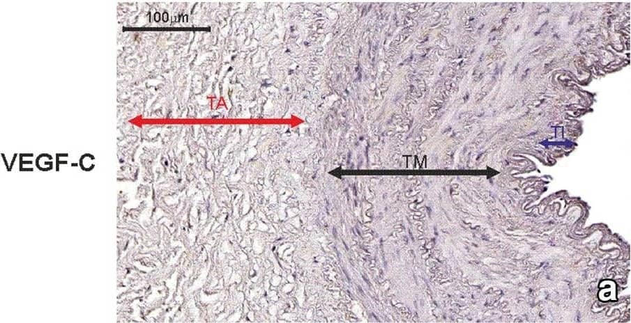 Immunohistochemistry: VEGF-C Antibody (107/F10) - Azide and BSA Free [NBP1-18626] - Immunohistochemical staining of an internal thoracic artery & saphenous vein wall harvested from a patient with no evidence of luminal stenosis 12 months after CABG. Immunohistochemical staining of VEGF-C (a) & CAV2 (b) in an internal thoracic artery (ITA) graft & VEGFR-3 (c) in saphenous vein (SV) transplant harvested from a 65-year-old patient diagnosed with triple-vessel CAD. Note that lack of CAV2 expression within smooth muscle cells (SMC) in ITA wall is accompanied by VEGF-C positive expression in the same area. In SV tissue sample harvested from the same patient, no VEGRR-3 expression was found. d Negative control. TI tunica intima, TM tunica media, TA tunica adventitia Image collected & cropped by CiteAb from the following publication (//link.springer.com/10.1007/s00380-018-1158-9), licensed under a CC-BY license. Not internally tested by Novus Biologicals.