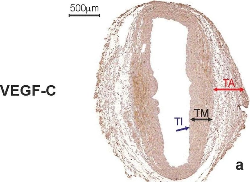 Immunohistochemistry: VEGF-C Antibody (107/F10) - Azide and BSA Free [NBP1-18626] - Immunohistochemical staining of a saphenous vein wall harvested from a patient diagnosed with triple-vessel CAD. Three serial histological sections of a graft wall obtained from a 71-year-old patient who developed early graft failure 11 months after coronary artery bypass grafting (the same patients as mentioned in Fig. 7). VEGF-C (a), VEGFR-3 (b), & CAV3 (c) shown to be expressed by immunohistochemical staining in smooth muscle cells of the tunica media (TM). In addition, VEGFR-3 is strongly present in endothelial cells of the tunica intima (TI). d Negative control. TA tunica adventitia Image collected & cropped by CiteAb from the following publication (//link.springer.com/10.1007/s00380-018-1158-9), licensed under a CC-BY license. Not internally tested by Novus Biologicals.