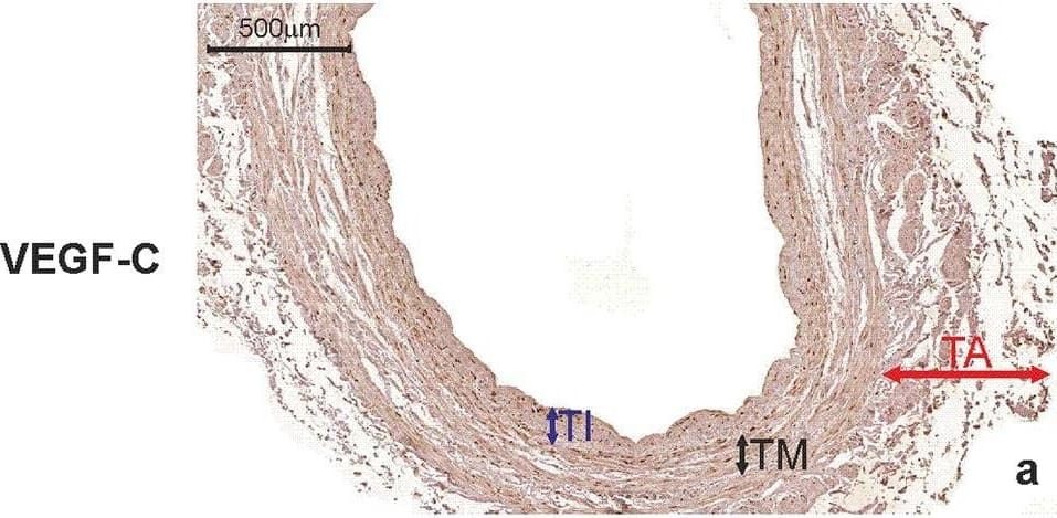 Immunohistochemistry: VEGF-C Antibody (107/F10) - Azide and BSA Free [NBP1-18626] - Saphenous vein wall harvested from a patient diagnosed with double-vessel CAD showing immunohistochemical staining. VEGF-C (a) & VEGFR-3 (b) reactivity in a graft wall obtained from a 67-year-old patient who developed the early graft restenosis within 7 months after coronary artery bypass grafting (the same patient as mentioned in Fig. 6). VEGF-C is localized exclusively within individual smooth muscle cells of the tunica media (TM). Cells with positive VEGFR-3 expression are situated in endothelial cells of the tunica intima (TI). c Negative control. TA tunica adventitia Image collected & cropped by CiteAb from the following publication (//link.springer.com/10.1007/s00380-018-1158-9), licensed under a CC-BY license. Not internally tested by Novus Biologicals.