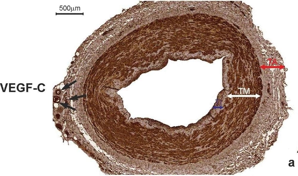 Immunohistochemistry: VEGF-C Antibody (107/F10) - Azide and BSA Free [NBP1-18626] - Immunohistochemistry of an internal thoracic artery wall harvested from a patient diagnosed with triple-vessel CAD. Immunohistochemical staining of VEGF-C (a), CAV2 (b), & CAV3 (c) in an internal thoracic artery graft harvested from a 71-year-old patient who developed early graft failure 11 months after coronary artery bypass grafting. Intensive VEGF-C & CAV3 expression is observed in the smooth muscle cells of the tunica media (TM) & in the endothelial cells of the tunica intima (TI). The presence of immunopositive expression of CAV2 (c) is limited to smooth muscle cells of the tunica media (TM). Expression of all analyzed proteins is present in the small blood vessels localized in the tunica adventitia (TA, arrows). d Negative control Image collected & cropped by CiteAb from the following publication (//link.springer.com/10.1007/s00380-018-1158-9), licensed under a CC-BY license. Not internally tested by Novus Biologicals.