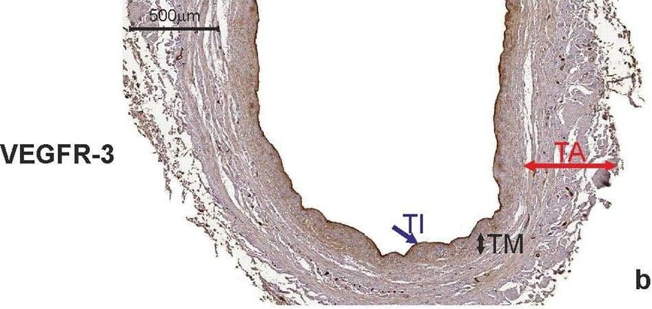 Immunohistochemistry: VEGFR3/Flt-4 Antibody (9D9) - Azide and BSA Free [NBP1-18651] - Saphenous vein wall harvested from a patient diagnosed with double-vessel CAD showing immunohistochemical staining. VEGF-C (a) & VEGFR-3 (b) reactivity in a graft wall obtained from a 67-year-old patient who developed the early graft restenosis within 7 months after coronary artery bypass grafting (the same patient as mentioned in Fig. 6). VEGF-C is localized exclusively within individual smooth muscle cells of the tunica media (TM). Cells with positive VEGFR-3 expression are situated in endothelial cells of the tunica intima (TI). c Negative control. TA tunica adventitia Image collected & cropped by CiteAb from the following publication (//link.springer.com/10.1007/s00380-018-1158-9), licensed under a CC-BY license. Not internally tested by Novus Biologicals.