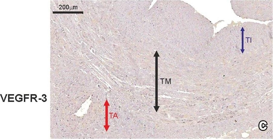 Immunohistochemistry: VEGFR3/Flt-4 Antibody (9D9) - Azide and BSA Free [NBP1-18651] - Immunohistochemical staining of an internal thoracic artery & saphenous vein wall harvested from a patient with no evidence of luminal stenosis 12 months after CABG. Immunohistochemical staining of VEGF-C (a) & CAV2 (b) in an internal thoracic artery (ITA) graft & VEGFR-3 (c) in saphenous vein (SV) transplant harvested from a 65-year-old patient diagnosed with triple-vessel CAD. Note that lack of CAV2 expression within smooth muscle cells (SMC) in ITA wall is accompanied by VEGF-C positive expression in the same area. In SV tissue sample harvested from the same patient, no VEGRR-3 expression was found. d Negative control. TI tunica intima, TM tunica media, TA tunica adventitia Image collected & cropped by CiteAb from the following publication (//link.springer.com/10.1007/s00380-018-1158-9), licensed under a CC-BY license. Not internally tested by Novus Biologicals.