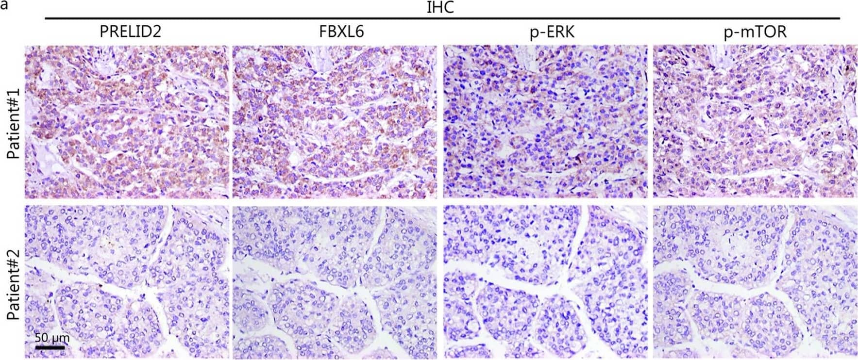 Elevated PRELID2 is positively correlated with the FBXL6/p-ERK/p-mTOR pathway and poor prognosis of HCC. a Representative images of IHC staining for FBXL6, PRELID2, p-ERK, and p-mTOR in human HCC tumors. Scale bar = 50 um. b The association between PRELID2 and FBXL6, p-ERK, or p-mTOR in 129 paired HCC tumors and adjacent normal tissues was analyzed by χ2 test. c The prognostic significance of PRELID2 in HCC patients was evaluated by Kaplan–Meier analysis. High expression of PRELID2 predicted a shorter overall survival (OS) time. d The association between FBXL6 and p-ERK/p-mTOR protein levels in 129 HCC tissues was evaluated by the χ2 test. e The prognostic significance of the coexpression of FBXL6 and p-ERK in HCC patients was evaluated by Kaplan–Meier analysis. f Kaplan–Meier survival curves showing the overall survival of FBXL6high/p-ERKhigh HCC patients with high or low PRELID2 expression. PRELID2 the proteins of relevant evolutionary and lymphoid interest (PRELI) domain 2, FBXL6 F-box and leucine-rich repeat 6, ERK extracellular signal-regulated kinase, mTOR mammalian target of rapamycin, IHC immunohistochemistry, HCC hepatocellular carcinoma Image collected and cropped by CiteAb from the following open publication (//pubmed.ncbi.nlm.nih.gov/38124228), licensed under a CC-BY license. Not internally tested by Novus Biologicals.