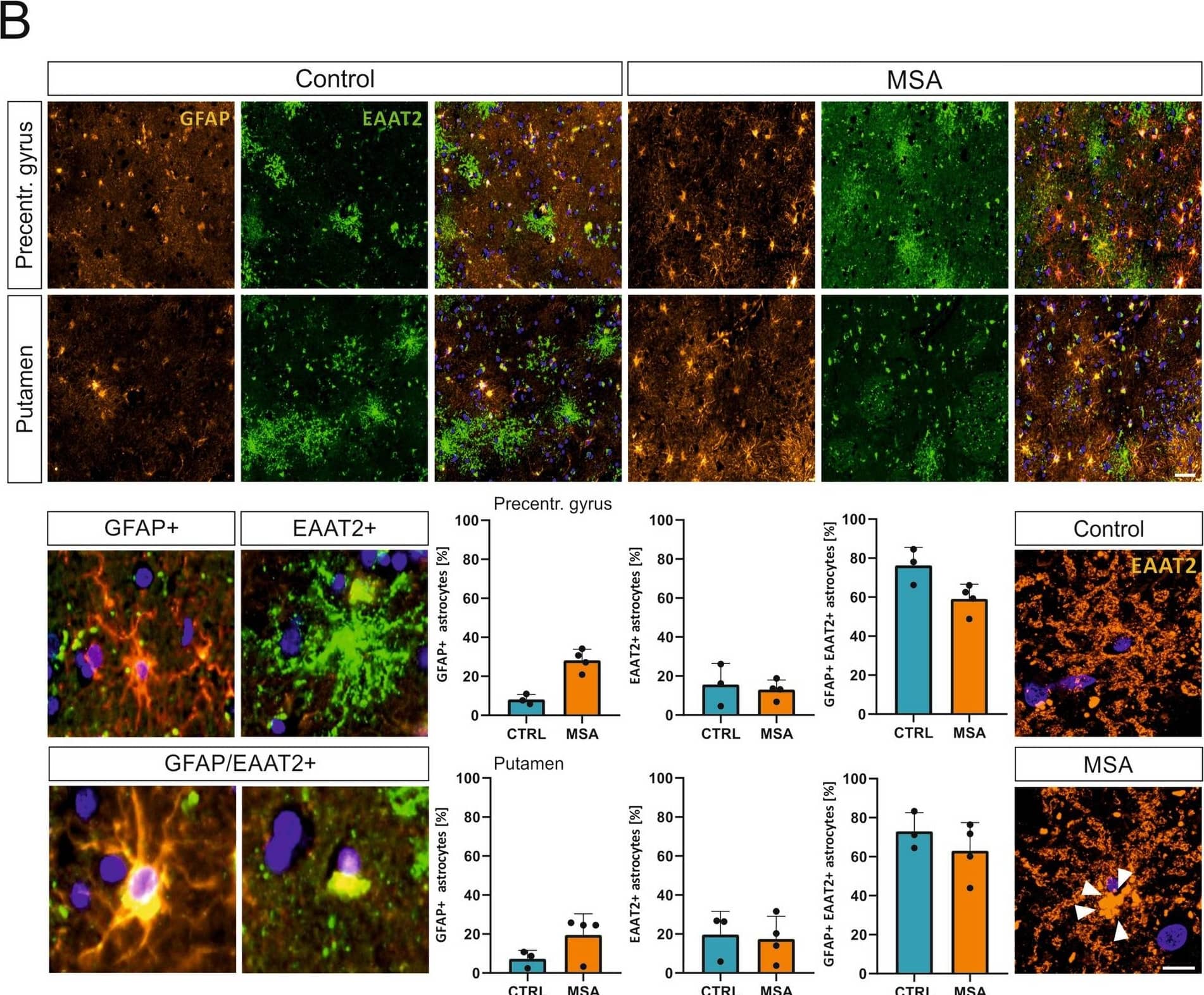 Astrogliosis in post mortem brain tissue of MSA patients. A Representative image of DAB staining of GFAP+ astrocytes in precentral gyrus, putamen, and substantia nigra of MSA-P patient (female, 67) and control individual (female, 60) and quantification of GFAP+ cells/mm2 (4 MSA patients vs. 4 Controls). SN was identified by presence of neuromelanin-containing neurons (white asterisks). Welch’s t-test was used for statistical analysis. Scale bar = 20 um. All three regions display elevated numbers of GFAP+ astrocytes in cortex (p = 0.002), putamen (p = 0.0003), and substantia nigra (p < 0.0001) of MSA patients. CTRL = Control, MSA = multiple system atrophy, SN = substantia nigra. (B, Upper panel) Immunofluorescence staining of four MSA-P patients and three controls. For visualization of astrocytes GFAP was used as a marker (orange). To analyze expression of glutamate reuptake transporter tissue was stained for EAAT2 (green). Scale bar = 50 um. (B, Lower panel) Overview of single cells expressing GFAP, EAAT2, and GFAP/EAAT2 (yellow, lower panel). Astrocytic GFAP/EAAT2 expression is decreased in the precentral gyrus (p = 0.0571). Moreover, a re-distribution towards the cytoplasm of EAAT2 is observed in astrocytes of MSA patients (Lower right panel) Image collected and cropped by CiteAb from the following open publication (//pubmed.ncbi.nlm.nih.gov/38167307), licensed under a CC-BY license. Not internally tested by Novus Biologicals.