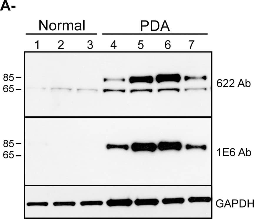 Western Blot: Palladin Antibody (1E6) [NBP1-25959] - Detection of palladin in post-surgical samples collected with 18-gauge needles.A. Samples of normal (lane 1 to 3) & pancreatic adenocarcinoma (lanes 4 to 7) were obtained from donated post-surgical organs using 18-gauge needles. Tissue samples were snap-frozen, ground, lysed & analyzed as in Figure 1. The blot was stained with both monoclonal (1E6) & polyclonal (622) palladin antibodies, & the major band (85–90 kDa) was detected by both antibodies in all tumor samples. B. Same samples (normal, lane 1–3 & PDA, lane 4–7) were analyzed for epithelial vs myofibroblast markers. The blot was stained with both, anti-E-cadherin antibody (as an epithelial cell marker) & anti-alpha SMA antibody (as a myofibroblast marker). Blots were stained for tubulin as a control for equal loading. Image collected & cropped by CiteAb from the following publication (//dx.plos.org/10.1371/journal.pone.0010347), licensed under a CC-BY license. Not internally tested by Novus Biologicals.