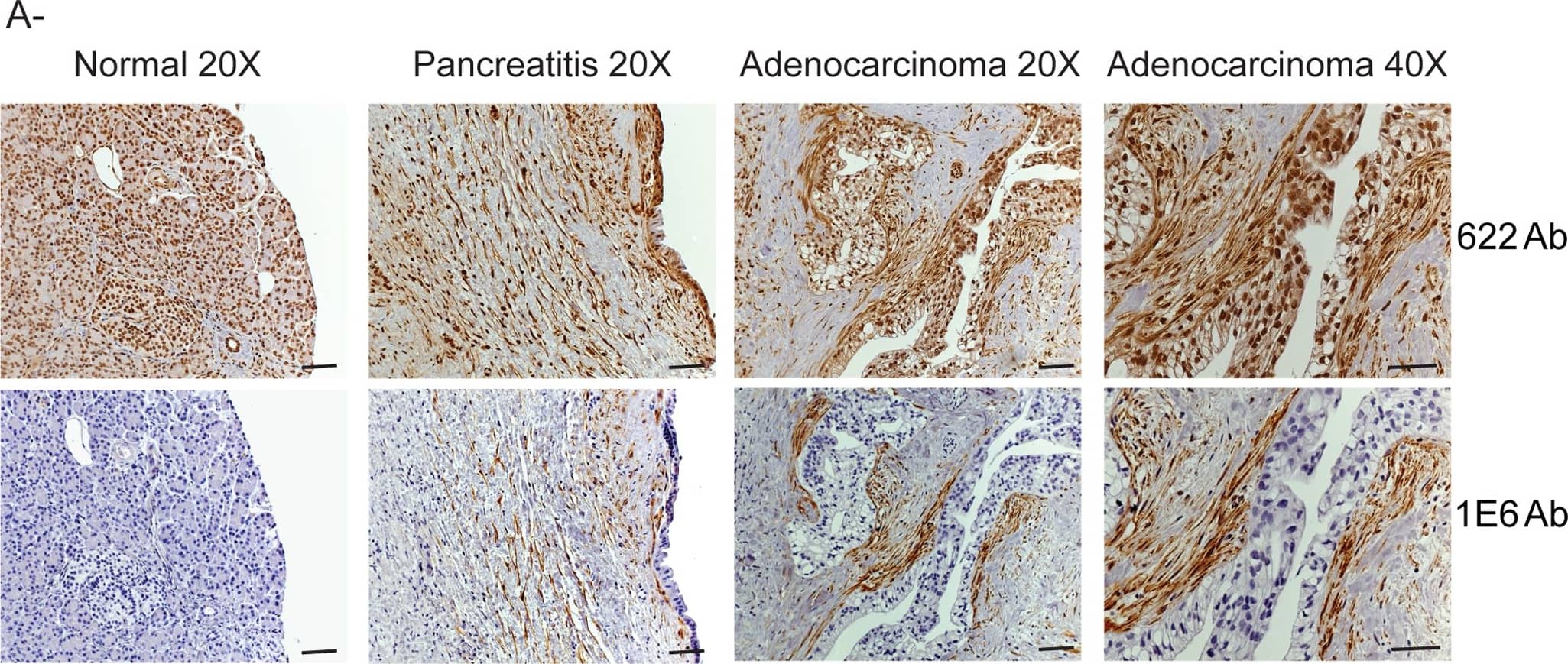 Immunohistochemistry: Palladin Antibody (1E6) [NBP1-25959] - Palladin staining of paraffin-embedded patient tissues.A. IHC staining was performed using standard antigen-retrieval protocols, & counter-stained with hematoxylin. Tissue sections were stained for palladin using two palladin antibodies: polyclonal 622 & monoclonal 1E6. Palladin stain is detected with brown reaction product. In tumor sections, palladin is detected at dramatically elevated levels in the stromal fibroblasts. Note also the expanded stroma around the neoplastic cells, which is characteristic of the desmoplastic reaction. Scale bars, 200 µM. B. Quantification of immunohistochemistry results. Ten sections each of normal pancreatitis & adenocarcinoma specimens were stained with four different antibodies (622, COM, 1E6 & 4D10) & scored by two pathologists, as described in the text. Results for both ductal epithelium (left) & stroma (right) stained with various palladin antibodies are shown for normal pancreas (n = 9, blue), pancreatitis (n = 7, red) & pancreatic adenocarcinoma (n = 10, yellow). The results confirmed that palladin levels are increased in the stroma, & not the epithelial tumor cells, of the adenocarcinomas. Although palladin levels are also increased in cases of chronic pancreatitis, they do not reach the same levels as in the tumors. Compared to the polyclonal 622 & COM, the monoclonal antibodies 1E6 & 4D10 are effective at distinguishing between pancreatitis & cancer. C. Double-label immunostaining for palladin (1E6 Ab) &  alpha -SMA in sections of pancreatic tumors confirms that palladin is strongly detected in a population of activated TAFs that surround the neoplastic cells. Scale bars, 200 µM. Image collected & cropped by CiteAb from the following publication (//dx.plos.org/10.1371/journal.pone.0010347), licensed under a CC-BY license. Not internally tested by Novus Biologicals.