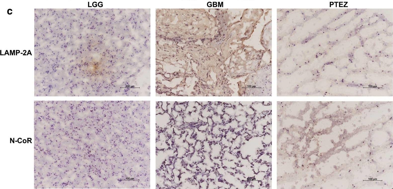 Immunocytochemistry/ Immunofluorescence: NCOR1 Antibody (7A7A9) - BSA Free [NBP1-28863] - Expressive analysis of LAMP-2A & N-CoR in clinical samples. a mRNA levels of LAMP-2A & N-CoR were measured by qRT-PCR. b Protein levels of LAMP-2A & N-CoR were measured by western blot. LAMP-2A mRNA & protein levels were significantly increased in GBM center (n = 8) in comparison with peri-tumor edema zone (PTEZ, n = 8) (p < 0.0001), while increasing trend was observed as compared with low grade glioma (LGG, n = 8). The protein level of N-CoR, but not mRNA level was significantly decreased in GBM center as compared with PTEZ (p < 0.0001). Linear regression analysis incorporating data from LGG, GBM center & PTEZ revealed moderate negative correlation between protein expression of LAMP-2A & that of N-CoR (r =  − 0.6001, p = 0.0019). c Immunohistochemistry (IHC) analysis of LAMP-2A & N-CoR (brown signal) in glioma clinical samples. Nucleus (blue signal) was stained with hematoxylin; D. immunofluorescence (IF) analysis of LAMP-2A (green signal) & N-CoR (red signal) in glioma clinical samples. DNA (blue signal) was stained with DAPI. Both IHC & IF studies displayed upregulation of LAMP-2A & downregulation of N-CoR in GBM centers. The data are mean ± SEM from 8 tissue specimens as a group. mRNA or protein levels are expressed relative to LGG set as 1. Significant changes are set as p < 0.05 & represented by asterisk (One-Way ANOVA; Bonferroni's test) Image collected & cropped by CiteAb from the following publication (//pubmed.ncbi.nlm.nih.gov/33761934), licensed under a CC-BY license. Not internally tested by Novus Biologicals.