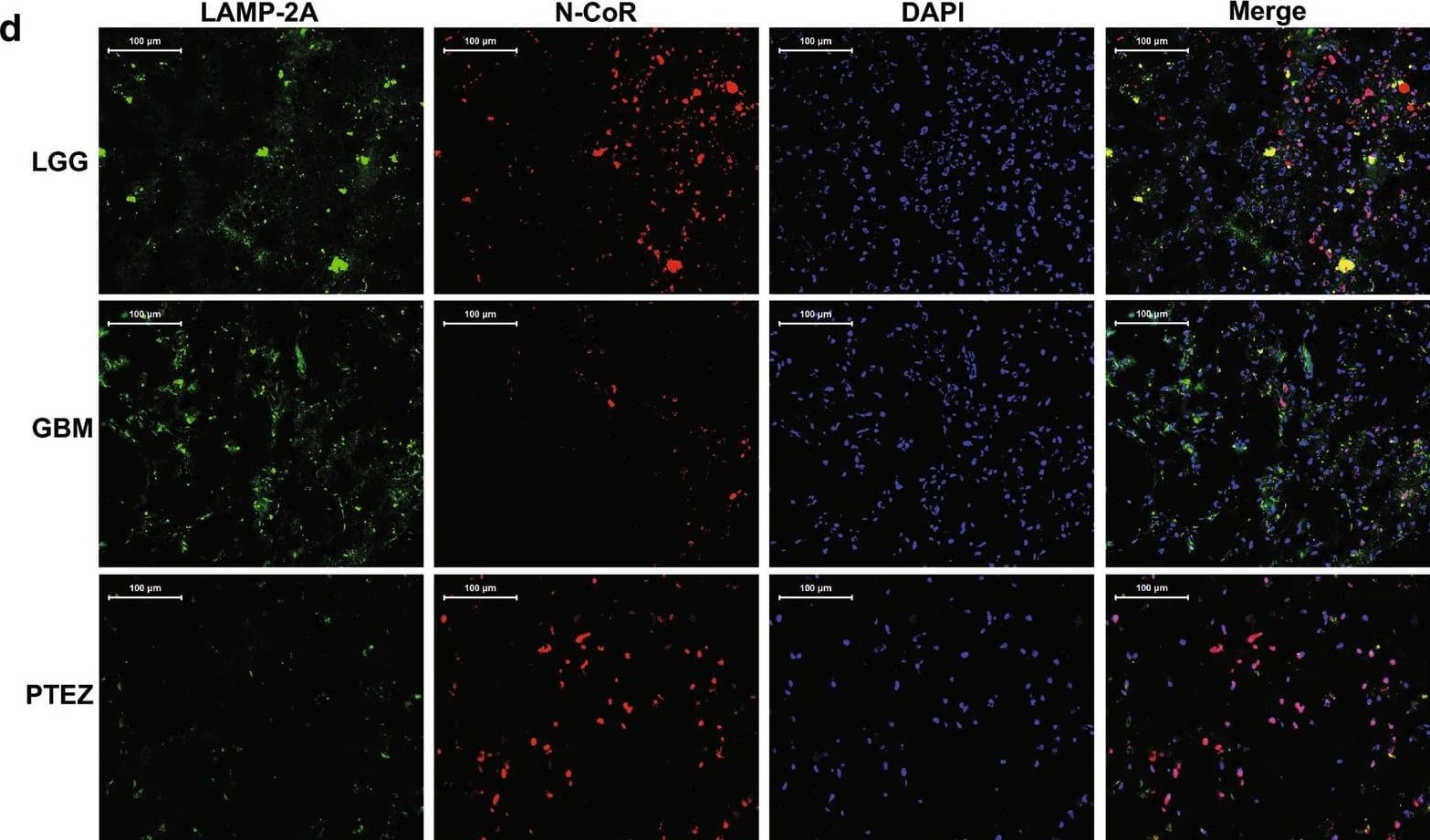 Immunocytochemistry/ Immunofluorescence: NCOR1 Antibody (7A7A9) - BSA Free [NBP1-28863] - Expressive analysis of LAMP-2A & N-CoR in clinical samples. a mRNA levels of LAMP-2A & N-CoR were measured by qRT-PCR. b Protein levels of LAMP-2A & N-CoR were measured by western blot. LAMP-2A mRNA & protein levels were significantly increased in GBM center (n = 8) in comparison with peri-tumor edema zone (PTEZ, n = 8) (p < 0.0001), while increasing trend was observed as compared with low grade glioma (LGG, n = 8). The protein level of N-CoR, but not mRNA level was significantly decreased in GBM center as compared with PTEZ (p < 0.0001). Linear regression analysis incorporating data from LGG, GBM center & PTEZ revealed moderate negative correlation between protein expression of LAMP-2A & that of N-CoR (r =  − 0.6001, p = 0.0019). c Immunohistochemistry (IHC) analysis of LAMP-2A & N-CoR (brown signal) in glioma clinical samples. Nucleus (blue signal) was stained with hematoxylin; D. immunofluorescence (IF) analysis of LAMP-2A (green signal) & N-CoR (red signal) in glioma clinical samples. DNA (blue signal) was stained with DAPI. Both IHC & IF studies displayed upregulation of LAMP-2A & downregulation of N-CoR in GBM centers. The data are mean ± SEM from 8 tissue specimens as a group. mRNA or protein levels are expressed relative to LGG set as 1. Significant changes are set as p < 0.05 & represented by asterisk (One-Way ANOVA; Bonferroni's test) Image collected & cropped by CiteAb from the following publication (//pubmed.ncbi.nlm.nih.gov/33761934), licensed under a CC-BY license. Not internally tested by Novus Biologicals.