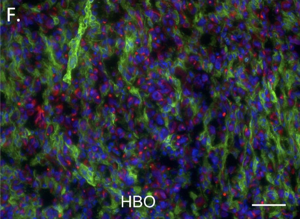 Immunocytochemistry/ Immunofluorescence: Cytokeratin 7 Antibody (R17-S) [NBP1-30152] - Collagen type I.The total amount of collagen type I quantified as percent of total area in both control (n = 5 tumors) & HBOT (n = 5 tumors) primary tumors (A) is shown. The total amount of ITGB1 as percent of total area in both control (n = 5 tumors) & HBOT (n = 5 tumors) primary tumors (B). A representative immunofluorescence (IF) staining picture from a control (C) & HBOT (D) tumor is shown. Green represents stroma cells (stained with antibody to mouse integrin-beta 1) red represents collagen type I secreted by the stromal cells (stained with antibody to mouse collagen type I), & blue shows the nuclei stained with DAPI. Scale bar represents 100 μm. Representative IF pictures are also shown to illustrate the compostion/proportion of the tumor cells (red, stained with cytokeratin 7 antibody) & the stromal cells (green, stained with integrin  beta 1 antibody) from the control (E) & and HBOT (F) tumors, respectively. Scale bar represents 100 μm. Image collected & cropped by CiteAb from the following publication (//pubmed.ncbi.nlm.nih.gov/28832662), licensed under a CC-BY license. Not internally tested by Novus Biologicals.