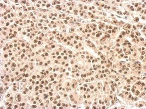 XRCC4 antibody detects XRCC4 protein at nucleus on HBL435 xenograft by immunohistochemical analysis. Sample: Paraffin-embedded HBL435 xenograft. XRCC4 antibody (NBP1-30878) dilution: 1:500. Antigen Retrieval: (EDTA based, pH 8.0) buffer, 15min 