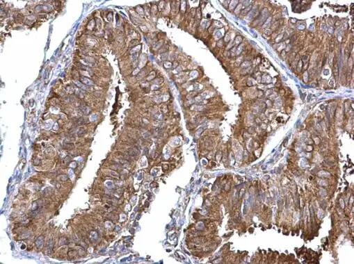 Immunohistochemistry: NM23-H1 Antibody [NBP1-30884] - NM23-H1 antibody [C1C3] detects NM23-H1 protein at cytosol on human endometrial carcinoma by immunohistochemical analysis. Sample: Paraffin-embedded human endometrial carcinoma. NM23-H1 antibody [C1C3] (NBP1-30884) dilution: 1:500.Antigen Retrieval: Trilogy™ (EDTA based, pH 8.0) buffer, 15min