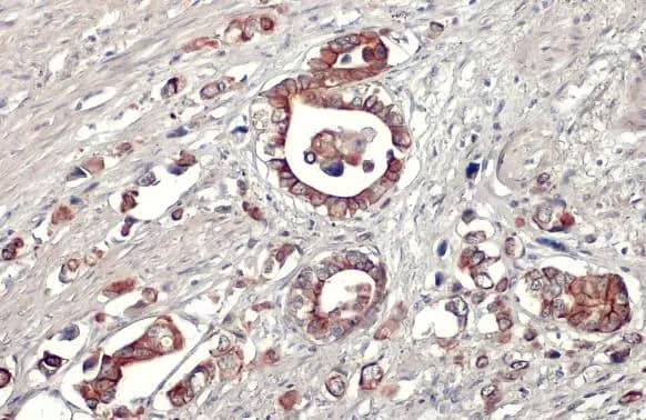 Immunohistochemistry-Paraffin: AMID Antibody [NBP1-31079] - AMID antibody [N1], N-term detects AMID protein at cell membrane and cytoplasm by immunohistochemical analysis.Sample: Paraffin-embedded human gastric cancer.AMID stained by AMID antibody [N1], N-term (NBP1-31079) diluted at 1:500.Antigen Retrieval: Citrate buffer, pH 6.0, 15 min
