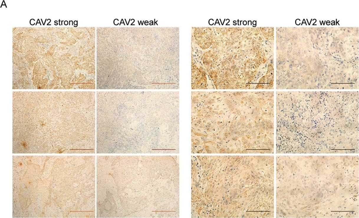High expression of CAV2 is associated with the poor prognosis of HNSCC patients.A IHC analysis of CAV2 levels in 211 human HNSCC samples (scale bar, 100 μm or 400 μm). B Kaplan–Meier survival curve showing the correlation of overall survival and disease-free survival with the CAV2 IHC score. Image collected and cropped by CiteAb from the following open publication (//pubmed.ncbi.nlm.nih.gov/36114176), licensed under a CC-BY license. Not internally tested by Novus Biologicals.