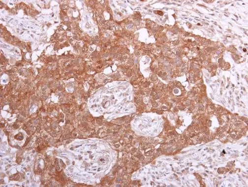 Immunohistochemistry-Paraffin: Inorganic Pyrophosphatase/PPA1 Antibody [NBP1-31348] - Inorganic Pyrophosphatase/PPA1 antibody detects Inorganic Pyrophosphatase/PPA1 protein at cytoplasm in human breast carcinoma by immunohistochemical analysis. Sample: Paraffin-embedded human breast carcinoma. Inorganic Pyrophosphatase/PPA1 antibody (NBP1-31348) diluted at 1:500.Antigen Retrieval: Citrate buffer, pH 6.0, 15 min