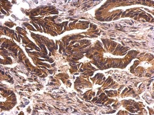 Immunohistochemistry: PKN2 Antibody [NBP1-31367] - PRK2 antibody [N1N3] detects PRK2 protein at cytosol on human colon carcinoma by immunohistochemical analysis. Sample: Paraffin-embedded human colon carcinoma. PRK2 antibody [N1N3] (NBP1-31367) dilution: 1:500.Antigen Retrieval: Trilogy™ (EDTA based, pH 8.0) buffer, 15min