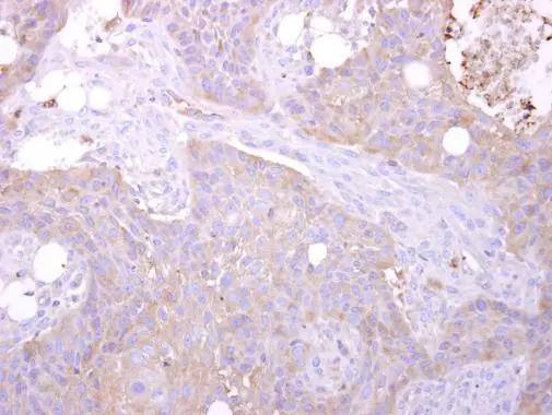 STK24 antibody [N1C1] detects STK24 protein at cytosol on HSC-3 xenograft by immunohistochemical analysis. Sample: Paraffin-embedded HSC-3 xenograft. STK24 antibody [N1C1] (NBP1-31575) dilution: 1:500. Antigen Retrieval: (EDTA based, pH 8.0) buffer, 15min 