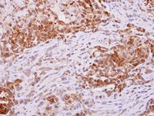 PGD antibody [N1N3] detects PGD protein at cytoplasm on A549 xenograft by immunohistochemical analysis. Sample: Paraffin-embedded A549 xenograft. PGD antibody [N1N3] (NBP1-31589) dilution: 1:500.Antigen Retrieval: (EDTA based, pH 8.0) buffer, 15min 