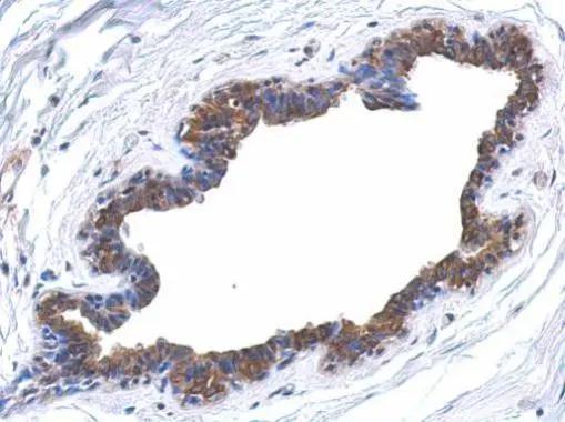 Immunohistochemical analysis of paraffin-embedded human breast cancer, using ERK4/MAPK4(NBP1-31594) antibody at 1:500 dilution. ^[^GTX]br>Antigen Retrieval: Trilogy� (EDTA based, pH 8.0) buffer, 15min 