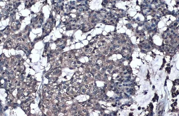 Immunohistochemistry-Paraffin: GGT1 Antibody [NBP1-32412] - GGT1 antibody detects GGT1 protein at cell membrane by immunohistochemical analysis.Sample: Paraffin-embedded human breast carcinoma.GGT1 stained by GGT1 antibody (NBP1-32412) diluted at 1:500.Antigen Retrieval: Citrate buffer, pH 6.0, 15 min