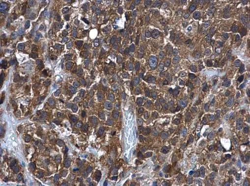 Immunohistochemistry: Glutathione S-transferase Mu 5 Antibody [NBP1-32682] - Glutathione S-transferase Mu 5 antibody detects Glutathione S-transferase Mu 5 protein at cytoplasm in human cervical cancer by immunohistochemical analysis. Sample: Paraffin-embedded human cervical cancer. Glutathione S-transferase Mu 5 antibody (NBP1-32682) diluted at 1:500.Antigen Retrieval: Citrate buffer, pH 6.0, 15 min