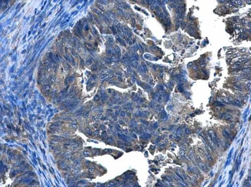 Immunohistochemistry: CCDC83 Antibody [NBP1-32738] - CCDC83 antibody [N1C2] detects CCDC83 protein at cytoplasm and nucleus in human endometrial cancer by immunohistochemical analysis. Sample: Paraffin-embedded human endometrial cancer. CCDC83 antibody [N1C2] (NBP1-32738) diluted at 1:500.Antigen Retrieval: Citrate buffer, pH 6.0, 15 min