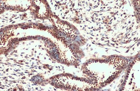 Immunohistochemistry-Paraffin: Nrf2 Antibody [NBP1-32822] - Nrf2 antibody [N2C2], Internal detects Nrf2 protein at cytoplasm and nucleus by immunohistochemical analysis.Sample: Paraffin-embedded human breast carcinoma.Nrf2 stained by Nrf2 antibody [N2C2], Internal (NBP1-32822) diluted at 1:500.Antigen Retrieval: Citrate buffer, pH 6.0, 15 min