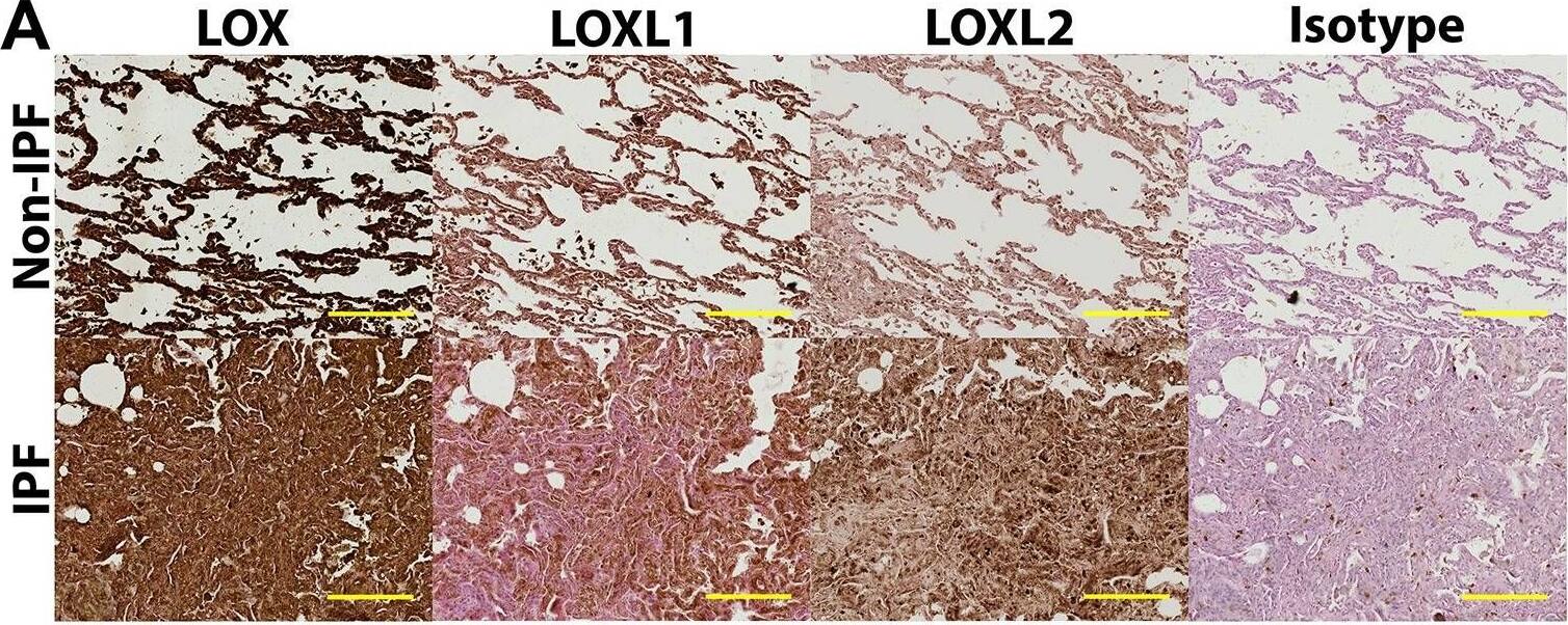 Collagen organization and lysyl oxidase family of enzymes are differentially expressed andinterrelatedifferently in IPF. (A) Representative IHC images of lysyl oxidase enzymes in the lungs. Images are representative of lung tissues from non-IPF (n=10) and IPF (n=8) subjects (brown, protein of interest; blue, nucleus; pink, cytoplasm; scale bar: 200 um). (B) The ratio of LOX and LOXL1 percentage surface area obtained by image analysis of IHC-stained lung tissues of non-IPF (n=10; open circles) compared with IPF (n=8; filled diamonds) subjects; data were analysed with Student's two-tailed parametric unpaired t-test. (C) Correlation of the ratio of LOX and LOXL1 with F/B ratio obtained through image analysis of SHG microscopy images of collagen structure in non-IPF (n=7) and IPF (n=8) subjects (P<0.0001; R2=0.7527; average of three or four samples per subject). (D) 3D scatter plot of collagen organization (intensity F/B, i.e. SHG intensity forward/backward signal ratio), LOXL1 and LOXL2 expression (open circles, non-IPF, n=7; filled circles, IPF, n=8). (E) Scree plot showing the number of relationship groups needed to explain the associations within measured variables in non-IPF and IPF tissues (eigenvalue threshold≥1). (F,G) Weighted average values of the variables contributing to each relationship group; comparing non-IPF with IPF subjects (average of three or four samples per subject); data were analysed with Student's two-tailed parametric unpaired t-test. Data are presented as means+/-s.d. Data were obtained from one experimental replicate per subject. *P<0.05, **P<0.01, ***P<0.005. Image collected and cropped by CiteAb from the following open publication (//pubmed.ncbi.nlm.nih.gov/29125826), licensed under a CC-BY license. Not internally tested by Novus Biologicals.