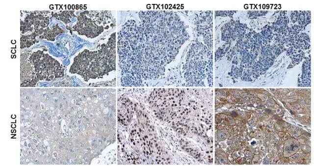Immunohistochemical characterization of Synaptophysin , p63  and Cytokeratin 7 (NBP1-33104) in human small cell lung cancer (SCLC) and non-small cell lung cancer (NSCLC) specimens.Sample: Paraffin-embedded human SCLC (upper panel) and NSCLC (lower panel).The section was pre-treated using heat mediated antigen retrieval with sodium citrate buffer (pH6) for 15 mins. The section was then incubated with primary antibody at 1:500 overnight at 4C and detected using an HRP conjugated avidin-biotin-peroxidase Complex system. DAB was used as the chromogen and counterstained with haematoxylin. br>Antigen Retrieval: Citrate buffer, pH 6.0, 15 min 
