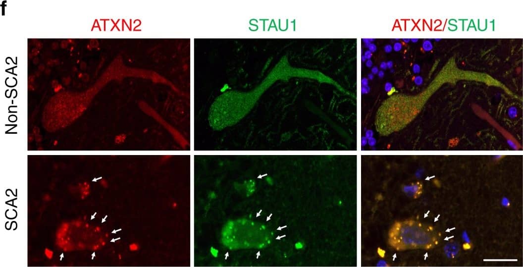 Western Blot: Staufen Antibody [NBP1-33202] - Silencing of STAU1 mitigates SCA2 phenotypes. aStau1 haploinsufficiency improves abnormal motor behavior of ATXN2Q127 mice as determined by rotarod behavior at 8, 12, 16, & 20 weeks of age. ATXN2Q127;Stau1+/- mice (green) have improved rotarod performance compared with ATXN2Q127 littermates (red) starting at 12 weeks of age. Note that Stau1 haploinsufficiency (orange) by itself does not alter motor function; n = 9–15 mice per group. Values shown are mean ± SE. Significance was determined using generalized estimating equations (GEE). NS, nonsignificant, *P  4 pixels per cell positive for both ATXN2 & STAU1 are shown. One-hundred normal & 96 SCA2-FBs were used for analyses. Data are mean ± SD, **P  4 pixels per cell positive for both ATXN2 & STAU1 are shown. One-hundred normal & 96 SCA2-FBs were used for analyses. Data are mean ± SD, **P  4 pixels per cell positive for both ATXN2 & STAU1 are shown. One-hundred normal & 96 SCA2-FBs were used for analyses. Data are mean ± SD, **P < 0.01, Student t-test. d Histograms representing the quantities & sizes of ATXN2-STAU1 co-localized granules in normal vs. SCA2 FBs. e In vivo co-localization of ATXN2 (green) with Stau1 (red) to aggregates in cerebellar PCs of 24-weeks-old ATXN2Q127 mice (white arrows). Scale bar, 30 µM. f Co-localized ATXN2 (red) & STAU1 (green) to aggregates (white arrows) in cerebellar PCs from a human SCA2 brain, that are absent in an unaffected control. Scale bar, 30 µM. g Immunoprecipitation of ATXN2 with STAU1. Non-RNase A or RNase A treated HEK-293 cell extracts expressing Flag-tagged ATXN2-(Q22 or Q108) were subjected to immunoprecipitation with Flag mAb beads & analyzed by western blotting. STAU1 shows RNA-dependent interactions with wild-type & mutant ATXN2. ATXN2 also co-immunoprecipitates with DDX6 & PABPC1, known ATXN2 interactors. Representative blots of three independent experiments are shown Image collected & cropped by CiteAb from the following publication (//pubmed.ncbi.nlm.nih.gov/30194296), licensed under a CC-BY license. Not internally tested by Novus Biologicals.