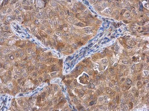 Immunohistochemistry: ACTL8 Antibody [NBP1-33497] - ACTL8 antibody detects ACTL8 protein at cytoplasm in human lung cancer by immunohistochemical analysis. Sample: Paraffin-embedded human lung cancer. ACTL8 antibody (NBP1-33497) diluted at 1:500.Antigen Retrieval: Citrate buffer, pH 6.0, 15 min