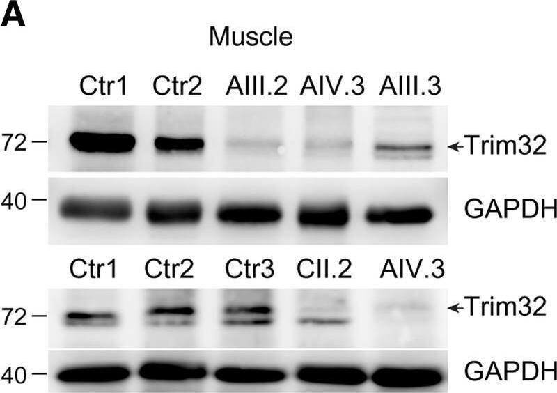 Reduced TRIM32 protein level associated with p.V591 M, p.N217S/F568del and p.C39LfsX17 mutations. a, b Western blot analysis of a muscle derived from biopsies of family A patients, family C patient and healthy controls, and b primary myoblasts from family A patients, family B patient, and healthy controls. Anti-TRIM32 antibody revealed a remarkable reduction of TRIM32 protein level in TRIM32V591M, TRIM32N217S/F568del and TRIM32C39LfsX17 samples compared with controls. An anti-GAPDH blot is shown as a loading control. Arrows indicate the correct band at 72 kDa. c. Immunofluorescence staining and quantification of the percentage of TRIM32+ cells (arrowheads) in primary myoblasts at 8 days growing in proliferation medium from family A patients (n = 2), family B patients (n = 2) and healthy controls (n = 7). Images show TRIM32 fluorescence (red). Cells were counterstained with Topro 3 (blue) to visualize the nuclei. The percentage of TRIM32+ cells was significantly lower in TRIM32V591M and TRIM32N217S/F568del myoblasts than in controls. Data from 9 to 31 independent fields were analyzed per condition. Mean +/- SEM; Kruskal-Wallis with Dunn’s multiple comparison test. Scale bar, 50 μm Image collected and cropped by CiteAb from the following open publication (//pubmed.ncbi.nlm.nih.gov/30823891), licensed under a CC-BY license. Not internally tested by Novus Biologicals.