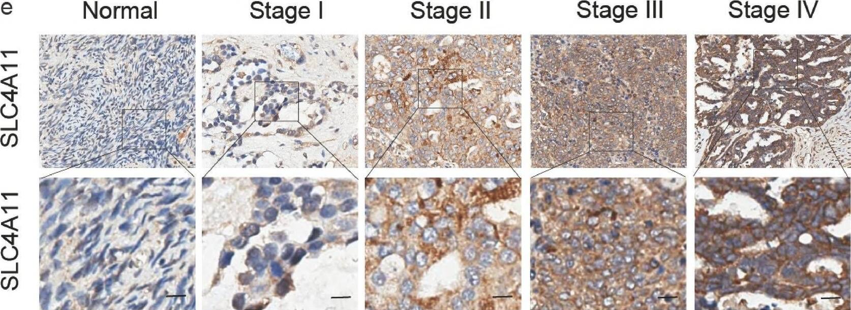SLC4A11 is linked to ovarian cancer. (a) Fifty-two genes whose expression was elevated in ovarian cancer tissue compared with healthy tissue are displayed in a Venn diagram. Data were obtained from the GSE40505, GSE18520, GSE66057, TCGA and GTEx datasets. (b) SLC4A11 mRNA expression levels in 88 nontumor tissues and 426 OV tissues from the GEPIA database. (c) SLC4A11 expression is used to predict the overall prognosis of ovarian cancer patients. Data obtained from GEPIA. (d) The degree of SLC4A11 expression in the GEO database (GSE40595, 63 OV, and 14 nontumor tissue samples; GSE18520, 53 OV and 10 nontumor tissue samples; GSE66957, 57 OV and 13 nontumor tissue samples). Chi-square test: *p < 0.05, **p < 0.01, ***p < 0.001. (e) SLC4A11 expression in OV tissue microarrays at various disease stages and in normal tissues. Scale bar: 50 uM. (f) The number of samples expressing SLC4A11 in OV samples (n = 117) and normal tissue samples (n = 16) was determined by blinded IHC. Scoring is based on staining intensity: negative (no positive colouration): 0 points; weak positive (light yellow): 1 point; positive (brownish yellow): 2 points; and strong positive (tan): 3 points. A score greater than 1 is considered high. Image collected and cropped by CiteAb from the following open publication (//pubmed.ncbi.nlm.nih.gov/40721447), licensed under a CC-BY license. Not internally tested by Novus Biologicals.
