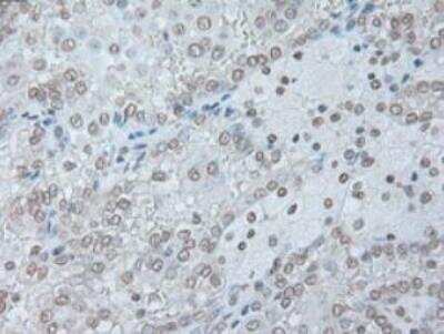 Immunohistochemistry-Paraffin: IL-6 Antibody (OTI3G9) [NBP1-47810] - Staining of Carcinoma of Human kidney tissue using anti-IL-6 mouse monoclonal antibody. (Heat-induced epitope retrieval by 10mM citric buffer, pH6.0, 100 degrees C for 10min.)