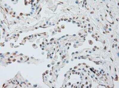 Immunohistochemistry-Paraffin: IL-6 Antibody (OTI3G9) [NBP1-47810] - Staining of Carcinoma of Human lung tissue using anti-IL-6 mouse monoclonal antibody. (Heat-induced epitope retrieval by 10mM citric buffer, pH6.0, 100 degrees C for 10min.)