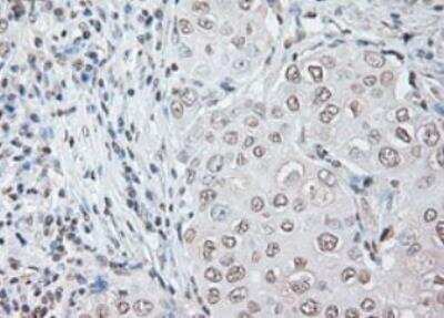 Immunohistochemistry-Paraffin: IL-6 Antibody (OTI3G9) [NBP1-47810] - Staining of Adenocarcinoma of Human breast tissue using anti-IL-6 mouse monoclonal antibody. (Heat-induced epitope retrieval by 10mM citric buffer, pH6.0, 100 degrees C for 10min.)