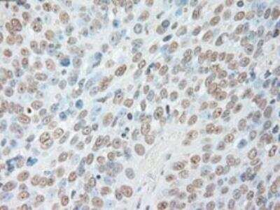 Immunohistochemistry-Paraffin: IL-6 Antibody (OTI3G9) [NBP1-47810] - Staining of Adenocarcinoma of Human ovary tissue using anti-IL-6 mouse monoclonal antibody. (Heat-induced epitope retrieval by 10mM citric buffer, pH6.0, 100 degrees C for 10min.)