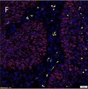 Representative IF IHC-stained sections of MDBMSCC demonstrating the expression of pSTAT3 [(A), red] and EMA [(A), green] by cells within the tumor nests. There was a CSC subpopulation remonstrating nuclear co-expression of STAT3 [(B), red] and CD34 [(B), green], appearing as orange, on the endothelium of the microvessels within the stroma; and another subpopulation staining only positively for pSTAT3 within the stroma [(B), red]. Nuclear expression of NANOG [(C), red] was demonstrated on the endothelium of the microvessels which expressed CD34 [(C), green] within stroma. The NANOG+ cells [(C), red] that do not express CD34 were seen within the tumor nests and the stroma. SOX2 [(D), red] was also expressed by cells within tumor nests and the stroma, and the endothelium of the microvessels expressing CD34 [(D), green]. Nuclear expression of both SOX2 [(E), red] and SALL4 [(E), green], appearing as orange, was seen on the cells within the tumor nests and the stroma. Expression of both SOX2 [(F), red] and OCT4 [(F), green], appearing as orange, was seen on cells within the tumor nests and the stroma, and the endothelium of the microvessels within the stroma. pSTAT3 [(G), red] and membranous staining CD44 [(G), green] were co-expressed by cells within the tumor nests. Scale bars: 20 μm. Image collected and cropped by CiteAb from the following open publication (//pubmed.ncbi.nlm.nih.gov/27532037), licensed under a CC-BY license. Not internally tested by Novus Biologicals.