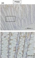 Expression of PKM1 and PKM2 in clinical colorectal cancer samples.(a) The protein expression of PKM1 and PKM2 in clinical specimens of cancer tumor (T) and the adjacent normal tissues (N) is shown. PKM1 and PKM2 were detected by Western blotting in under the same experimental conditions at the same time. The full-length blots are presented in Supplementary Figure S3b. (b–d) Immunohistochemical staining of normal colon tissue adjacent to tumor tissue of case 10. Results of H&E staining (b), staining with anti-PKM1 antibody (c), and staining with anti-PKM2 (d) are shown. The boxed regions in “c