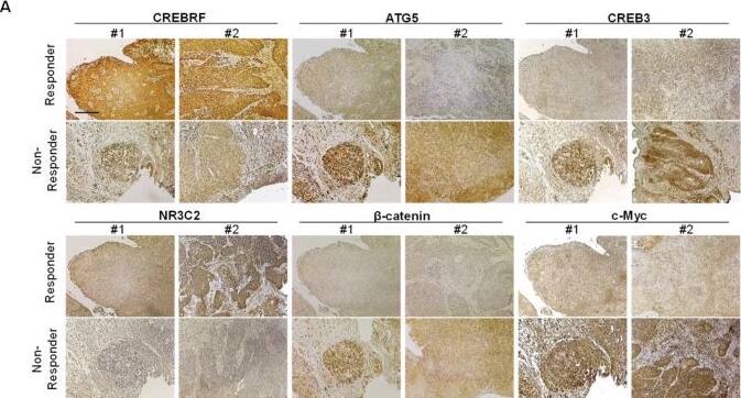 Downregulation of CREBRF and NR3C2 increase poor prognosis in HNSCC. (A) Histological analysis of miR124-3p and miR766-3p target gene expression (CREBRF-ATG5/CREB3, NR3C2-beta -catenin/c-Myc) in Responder vs. Non-Responder HNSCC clinical samples. Magnification, x100. Scale bar, 210 um. The quantitative data from all specimens are shown in the bar chart. Each dot in the graph represents an individual clinical sample. Two-sided unpaired Student t test was used to analyze comparisons, and data are presented as means +/- SEM. * p < 0.05 and *** p < 0.001. (B) Histological analysis of tumor morphology in relation to miR124-3p and miR766-3p target gene expression. Representative images of CREBRF, ATG5, CREB3, NR3C2,  beta -catenin, and c-Myc expression in the serial section of responder and non-responder HNSCC specimens. BV: Blood Vessel. T: Tumor. N: Normal tissue. The invasive cancer cells are indicated by red arrowhead. Magnification, ×200. Scale bar, 100 um. (C) Summary of resistance mechanisms regulated by miR124-3p and miR766-3p. Our data indicated that upon acquired resistance in HNSCC cells or in non-responder HNSCC tumors, the levels of miR124-3p and miR766-3p go up, which in turn down-regulate its direct target genes: CREBRF and NR3C2, and consequently the expression of downstream targets of CREBRF (ATG5/CREB3) and NR3C2 ( beta -catenin/c-Myc) increased in resistant tumors, which are positively correlated with poor prognosis. Thus, by enhancing the CREBRF-ATG5/CREB3 and NR3C2-beta -catenin/c-Myc axis, miR124-3p and miR766-3p support aggressive HNSCC progression. Image collected and cropped by CiteAb from the following open publication (//pubmed.ncbi.nlm.nih.gov/36358691), licensed under a CC-BY license. Not internally tested by Novus Biologicals.