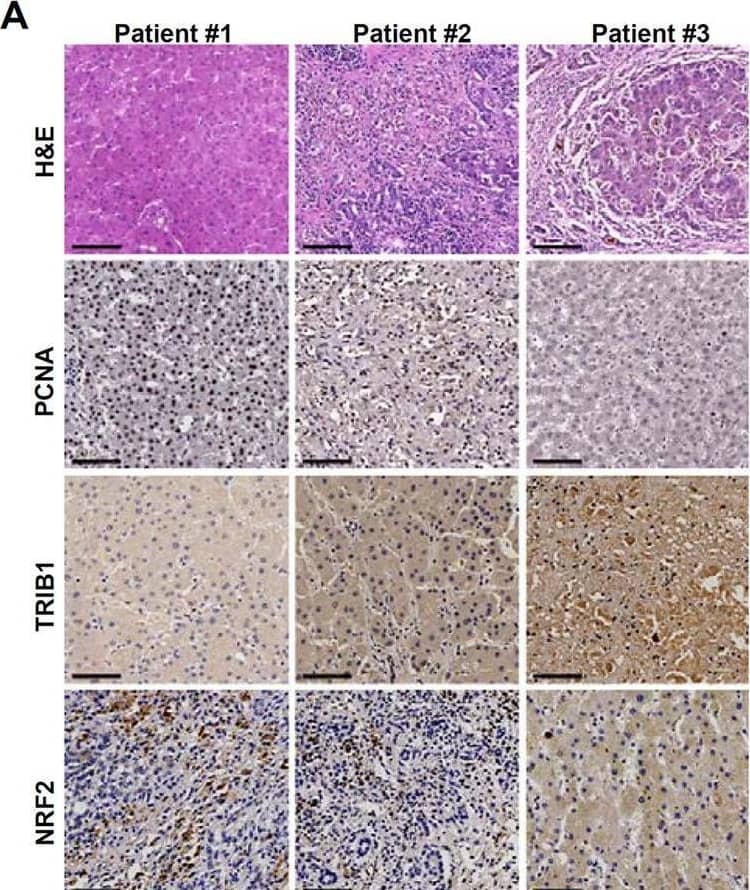 Correlation between TRIB1 expression, NRF2 nuclear localization, and hepatocyte proliferation in human ALF specimens.A Human liver biopsy specimens were stained with anti-TRIB1, anti-NRF2, and anti-PCNA. B Linear regression was performed with Graphpad. N = 9. C A schematic model. In quiescent hepatocytes, LXR alpha  binds to the Trib1 promoter and activates Trib1 transcription. Trib1 interacts with Nrf2 to sequester Nrf2 in the cytoplasm thus turning off the transcription of antioxidant genes. In proliferating hepatocytes during live regeneration, deactivation of LXR alpha  shuts down Trib1 transcription, which unleashes Nrf2 from sequestration. Nrf2 translocates to the nucleus and activates the transcription of antioxidant genes to modulate intracellular redox status fueling cell proliferation. Image collected and cropped by CiteAb from the following open publication (//pubmed.ncbi.nlm.nih.gov/37355685), licensed under a CC-BY license. Not internally tested by Novus Biologicals.
