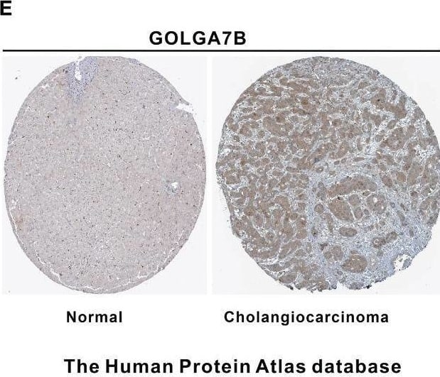 Identification of key genes related to CCA patient survival. (A) The forest plot shows the six survival-related genes in the yellow module identified by univariate Cox regression analysis. (B) Forest plot showing that GOLGA7B and AGAP2−AS1 were independent survival-related genes determined through multivariate Cox regression analysis. (C) Kaplan–Meier curves showing that CCA patients with higher expression of GOLGA7B had a high survival probability, and those with a higher expression of AGAP2−AS1 had a lower survival probability. (D) mRNA expression of GOLGA7B and AGAP2−AS1 between tumor and normal tissues in CCA patients in the training group. (E) Analysis of Human Protein Atlas database indicated that GOLGA7B protein expression was significantly upregulated in CCA tumor tissues compared with cholangiocytes. The CCA tumor tissue came from a 67-year-old man (patient ID: 3334; staining: medium; quantity: 25%-75%; intensity: moderate). The normal tissue came from a 55-year-old man (patient ID: 2399; staining: not detected; quantity:<25%; intensity: weak). (F) qRT-PCR confirmed that GOLGA7B and AGAP2−AS1 were overexpressed in tumor samples compared to normal tissue samples. (G) Western blotting confirmed that the protein expression of GOLGA7B was significantly upregulated in tumor samples compared with normal tissue samples. * P<0.05; *** P<0.001; **** P<0.0001. Image collected and cropped by CiteAb from the following open publication (//pubmed.ncbi.nlm.nih.gov/36591499), licensed under a CC-BY license. Not internally tested by Novus Biologicals.