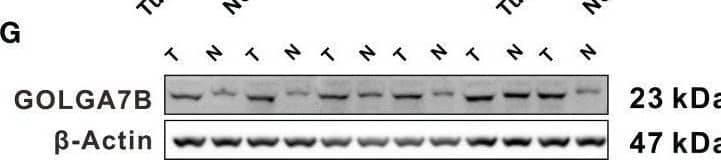 Identification of key genes related to CCA patient survival. (A) The forest plot shows the six survival-related genes in the yellow module identified by univariate Cox regression analysis. (B) Forest plot showing that GOLGA7B and AGAP2−AS1 were independent survival-related genes determined through multivariate Cox regression analysis. (C) Kaplan–Meier curves showing that CCA patients with higher expression of GOLGA7B had a high survival probability, and those with a higher expression of AGAP2−AS1 had a lower survival probability. (D) mRNA expression of GOLGA7B and AGAP2−AS1 between tumor and normal tissues in CCA patients in the training group. (E) Analysis of Human Protein Atlas database indicated that GOLGA7B protein expression was significantly upregulated in CCA tumor tissues compared with cholangiocytes. The CCA tumor tissue came from a 67-year-old man (patient ID: 3334; staining: medium; quantity: 25%-75%; intensity: moderate). The normal tissue came from a 55-year-old man (patient ID: 2399; staining: not detected; quantity:<25%; intensity: weak). (F) qRT-PCR confirmed that GOLGA7B and AGAP2−AS1 were overexpressed in tumor samples compared to normal tissue samples. (G) Western blotting confirmed that the protein expression of GOLGA7B was significantly upregulated in tumor samples compared with normal tissue samples. * P<0.05; *** P<0.001; **** P<0.0001. Image collected and cropped by CiteAb from the following open publication (//pubmed.ncbi.nlm.nih.gov/36591499), licensed under a CC-BY license. Not internally tested by Novus Biologicals.
