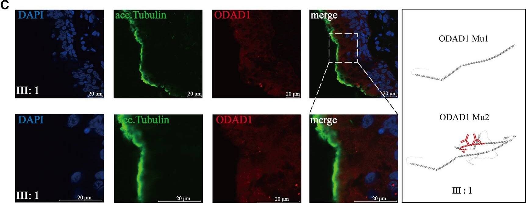 The ODAD1 mutation (c.71-2A > C; c.598-2A > C) led to the absence of wild-type ODAD1 and the defects of the outer dynein arm in ciliary axonemes and caused a decrease in ciliary beat frequency. (A) Diagram of ODAD1 demonstrating the antigenic site of the antibody used (red box) and the location of the mutation (arrow) in the patient. Yellow boxes represent predicted coiled-coil domains, and blue boxes represent disordered domains. (B) In control individuals, ODAD1 was localized along the length of the axoneme in ciliated cells. (C) In patient Ⅲ:1, the expression of ODAD1 was significantly low. Green, acetylated-alpha -tubulin; red, ODAD1; blue, DAPI. Scale bar = 20 μm. (D) Ultrastructure of the ciliary axonemes of the patient and control individuals was analyzed via TEM; defects in the ODA of ciliary axonemes were observed in the patient. While many ciliary cross-sections did not show ODA, some sections exhibited ODAs. The white asterisks indicate the structure of ODAs (scale bar = 100 nm). (E) CBF is significantly lower in the patient than in control individuals (***, p < 0.001). Image collected and cropped by CiteAb from the following open publication (//pubmed.ncbi.nlm.nih.gov/38028630), licensed under a CC-BY license. Not internally tested by Novus Biologicals.