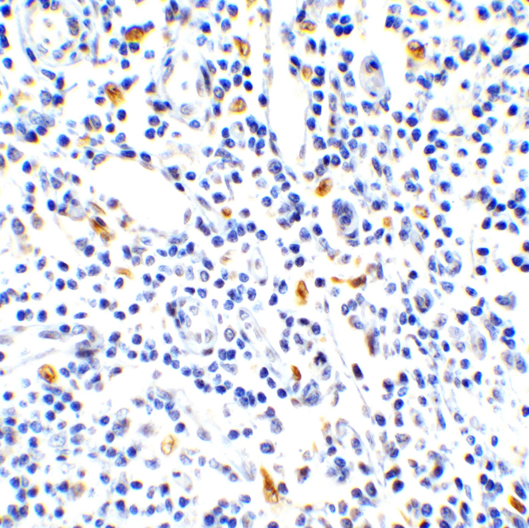 Immunohistochemistry: IL-17/IL-17A Antibody - BSA Free [NBP1-76337] - Validation of IL-17/IL-17A in Human Lymph Node.Immunohistochemical analysis of paraffin-embedded human lymph node tissue using anti-IL-17/IL-17A antibody  at 1 ug/ml. Tissue was fixed with formaldehyde and blocked with 10% serum for 1 h at RT; antigen retrieval was by heat mediation with a citrate buffer (pH6). Samples were incubated with primary antibody overnight at 4C. A goat anti-rabbit IgG H&L (HRP) at 1/250 was used as secondary. Counter stained with Hematoxylin.