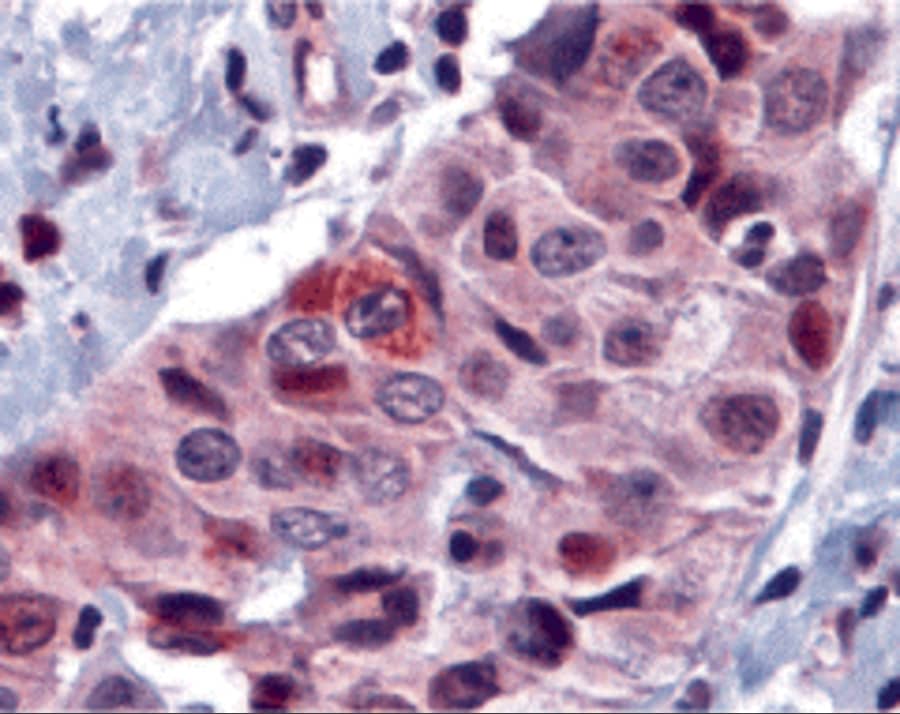 Immunohistochemistry: PUMA Antibody - BSA Free [NBP1-76639] -  Validation of PUMA in Human Breast Carcinoma.  Immunohistochemical analysis of paraffin-embedded human breast carcinoma tissue using anti-PUMA antibody  at 10 ug/ml. Tissue was fixed with formaldehyde and blocked with 10% serum for 1 h at RT; antigen retrieval was by heat mediation with a citrate buffer (pH6). Samples were incubated with primary antibody overnight at 4C. A goat anti-rabbit IgG H&L (HRP) at 1/250 was used as secondary. Counter stained with Hematoxylin.